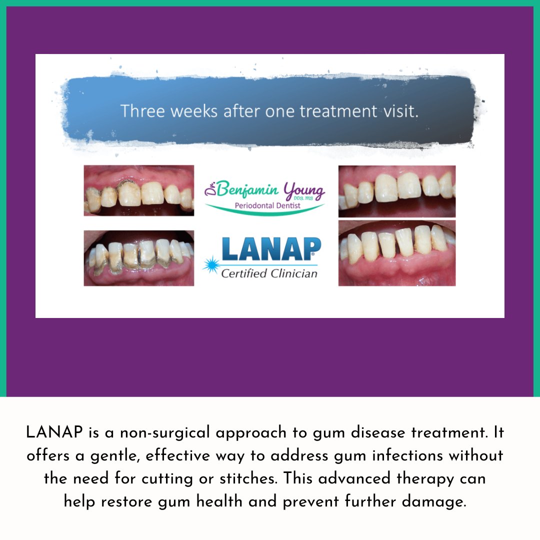 benyoungdds's tweet photo. LANAP, or Laser Assisted New Attachment Procedure, is a modern, FDA-approved laser treatment. It's a less invasive alternative to traditional gum surgery.

Schedule a consultation today to learn if LANAP is right for you.
Call Us Today 210-615-1995 https://t.co/IXsMT5EUy6