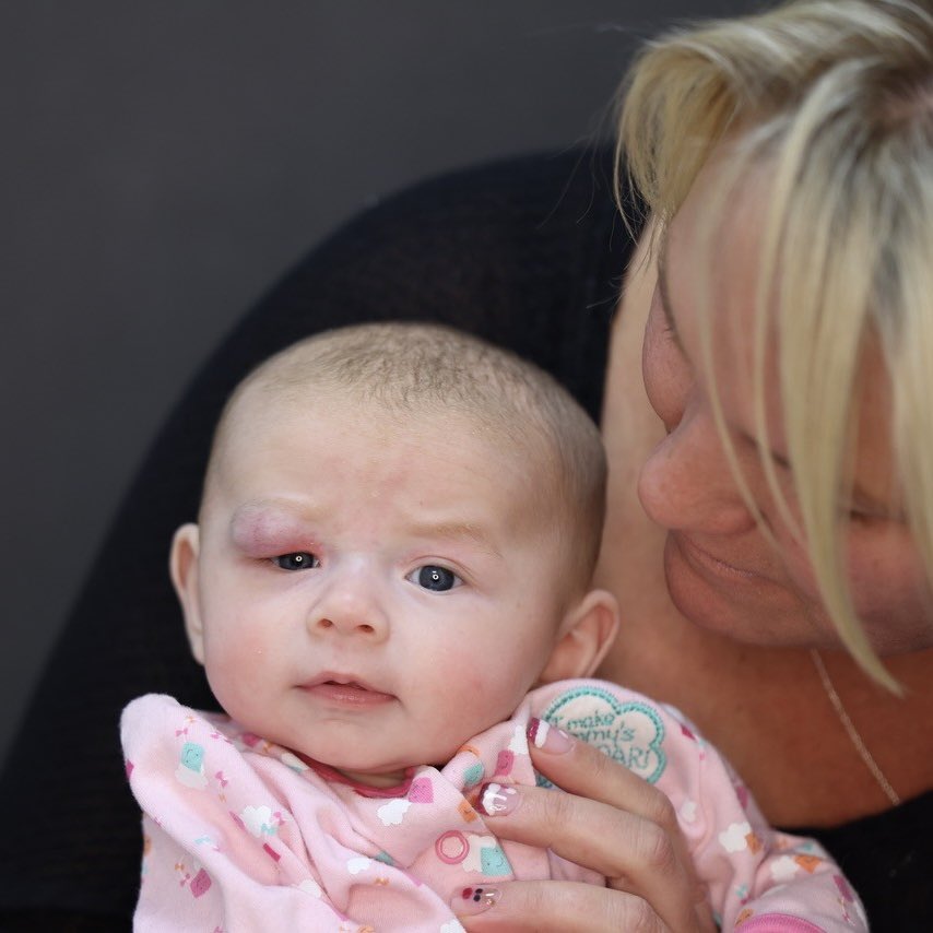 Tomorrow is surgery day for baby Maya, who has an extensive eyelid birthmark that is compressing her nerve. This urgent removal surgery will preserve her sight and prevent blindness. Visit the link below for updates or to share a donation. 😇💗 hannahstormfoundation.org