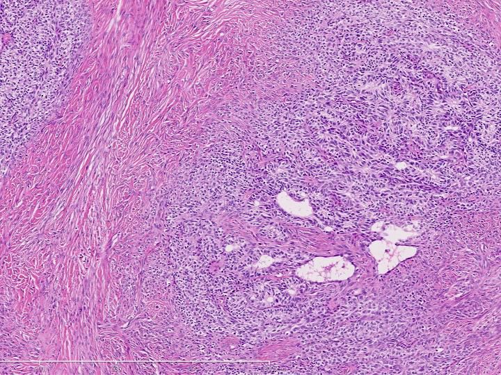 CuringN's tweet photo. Uterus - What's your diagnosis?

Topic link: https://t.co/JSdrrDHeTI

Images contributed by Ayse Ayhan, M.D., Ph.D.

Visit our CCN blog for cancer-related essays by Dr. Pernick: https://t.co/aaLBk9B2jb.

#Cancer #CancerResearch #CuringCancerNetwork #Pathology https://t.co/4c0rAmb1pa
