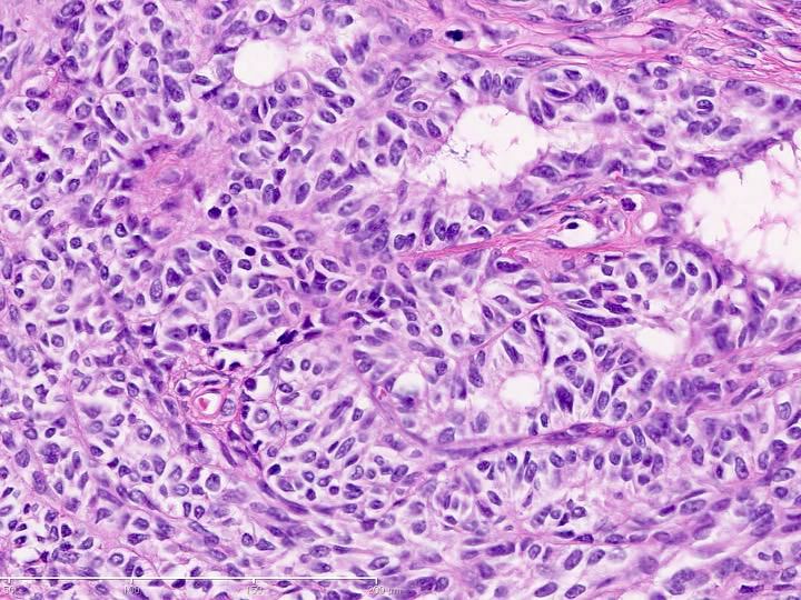 CuringN's tweet photo. Uterus - What's your diagnosis?

Topic link: https://t.co/JSdrrDHeTI

Images contributed by Ayse Ayhan, M.D., Ph.D.

Visit our CCN blog for cancer-related essays by Dr. Pernick: https://t.co/aaLBk9B2jb.

#Cancer #CancerResearch #CuringCancerNetwork #Pathology https://t.co/4c0rAmb1pa