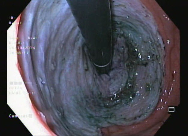 drbiswaPATRA's tweet photo. ESD for Rectal LST-G (mixed nodular), starting from anal verge extending till 8cm, complete circumferential excision..

How often do you encounter strictures in such cases? Your go to strategy for stricture prevention ?

#GITwitter #MedTwitter #ESD https://t.co/DQ1OOcYzuL