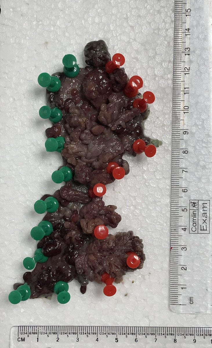 drbiswaPATRA's tweet photo. ESD for Rectal LST-G (mixed nodular), starting from anal verge extending till 8cm, complete circumferential excision..

How often do you encounter strictures in such cases? Your go to strategy for stricture prevention ?

#GITwitter #MedTwitter #ESD https://t.co/DQ1OOcYzuL