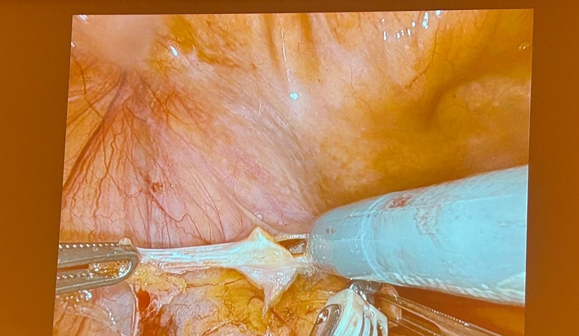 Guglielmo Mantica (@manticagu) on Twitter photo Great First day of the First #RARC robotic cystectomy ๐ค masterclass in Italy! Congratulation and ๐๐ป to <a href="/marchionimic/">Michele Marchioni</a> and <a href="/danieleamparore/">Daniele Amparore</a> for organizing a great event in the beautiful #abruzzo! ๐๏ธ๐๏ธ <a href="/PorpigliaF/">Porpiglia Francesco</a> Great First day of the First #RARC robotic cystectomy ๐ค masterclass in Italy! Congratulation and ๐๐ป to <a href="/marchionimic/">Michele Marchioni</a> and <a href="/danieleamparore/">Daniele Amparore</a> for organizing a great event in the beautiful #abruzzo! ๐๏ธ๐๏ธ <a href="/PorpigliaF/">Porpiglia Francesco</a>