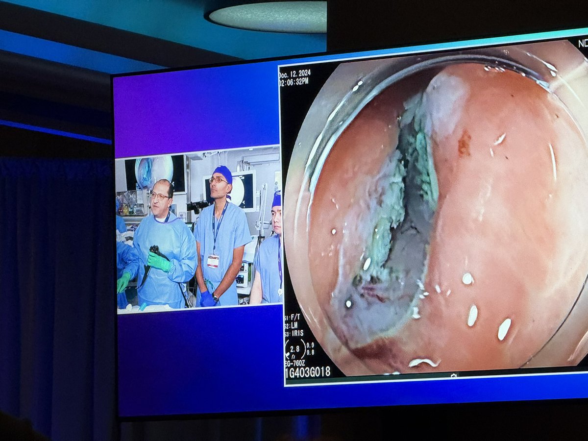Harika Kandlakunta (@harika_k_md) on Twitter photo Wonderful Live Endoscopy course on G-POEM at #NYSGE24 by <a href="/shandrawes/">Sherif Andrawes MD</a> <a href="/SIUHOSPITAL/">SIUH</a> <a href="/NorthwellHealth/">Northwell Health</a> Wonderful Live Endoscopy course on G-POEM at #NYSGE24 by <a href="/shandrawes/">Sherif Andrawes MD</a> <a href="/SIUHOSPITAL/">SIUH</a> <a href="/NorthwellHealth/">Northwell Health</a>