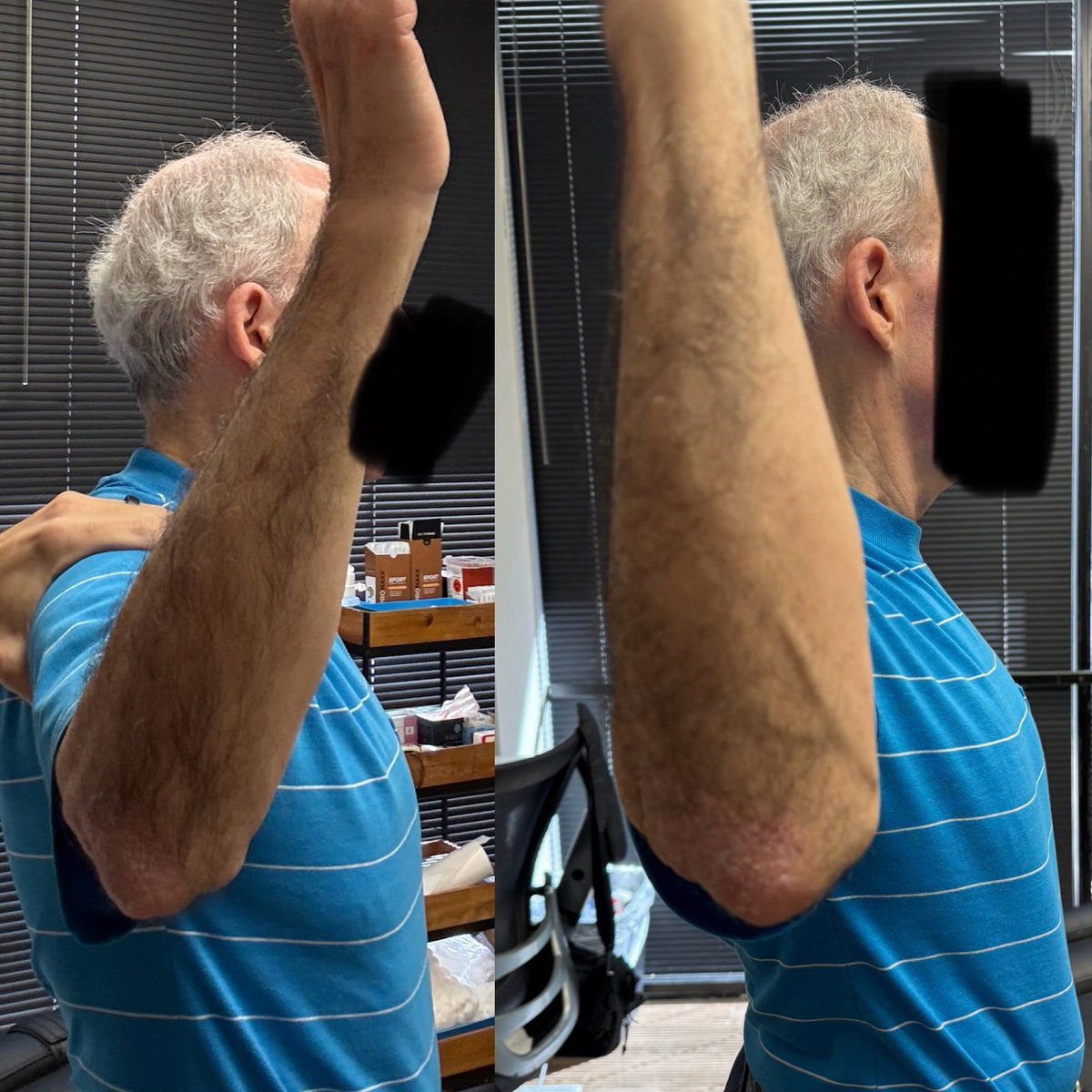 StrattonSpine's tweet photo. Pre and post treatment on a 74 year old patient. Patient was dealing with overhead mobility tightness. Capsular mobilizations were provided to increase flexibility.  Myofascial release to the latissimus Doris and Pectorals Major and some corrective exercises to take home. #rehab https://t.co/dMTDupzcOt