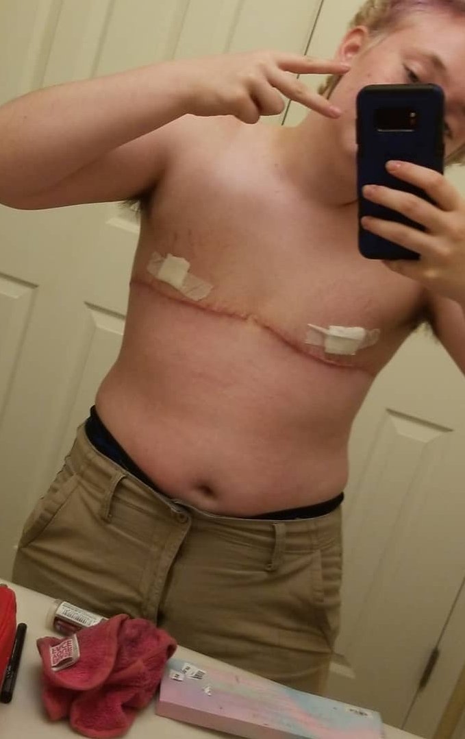 14 years old, with fresh mastectomy scars and a lifetime of regret ahead. no child can truly grasp the weight of such irreversible decisions. I share this to protect others from the same anguish. let kids be kids. #Detransition #StopTheHarm