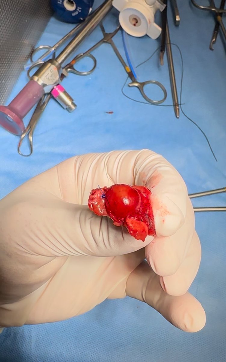 AhmedINazer's tweet photo. Laparoscopic partial nephrectomy at @SMCH_Riyadh 

clear margins
final pathology: oncocytoma.

this patient was scheduled for total kidney removal elsewhere for what turned out to be a benign tumor.

referring to specialists who can offer kidney-sparing options when possible makes all the difference.

عملية استئصال جزئي للكلية باستخدام المناظير بدون الفتح الجراحي الكامل. 

الغرض من العملية: وجود ورم بالكلية 

الجدير بالذكر ان المريض تم حجزه لعملية استئصال كامل للكلية في احد المستشفيات بحجة ان الاستئصال الجزئي للكلية غير آمن! ولكن المريض قرر ان يستشير رأيي طبي في مستشفى اخر ولله الحمد اجريت له عملية استئصال الورم عن طريق المنطار مع المحافظة على بقية الكلية بنجاح وغادر المريض المستشفى في اليوم الثاني بعد العملية. وبعد فحص الورم في المختبر تبين انه ورم حميد (لايمكن معرفته إلا بعد الاستئصال). فتخيل لو تم استئصال الكلية بالكامل من أجل ورم حميد!

استشارة الجراحين المتخصصين القادرين على تقديم خيارات الحفاظ على الكلية عند الإمكان له تأثير كبير على جودة حياة المريض

Thanks @sbinhamrii @BaderAlsaikhan for all the help and support.