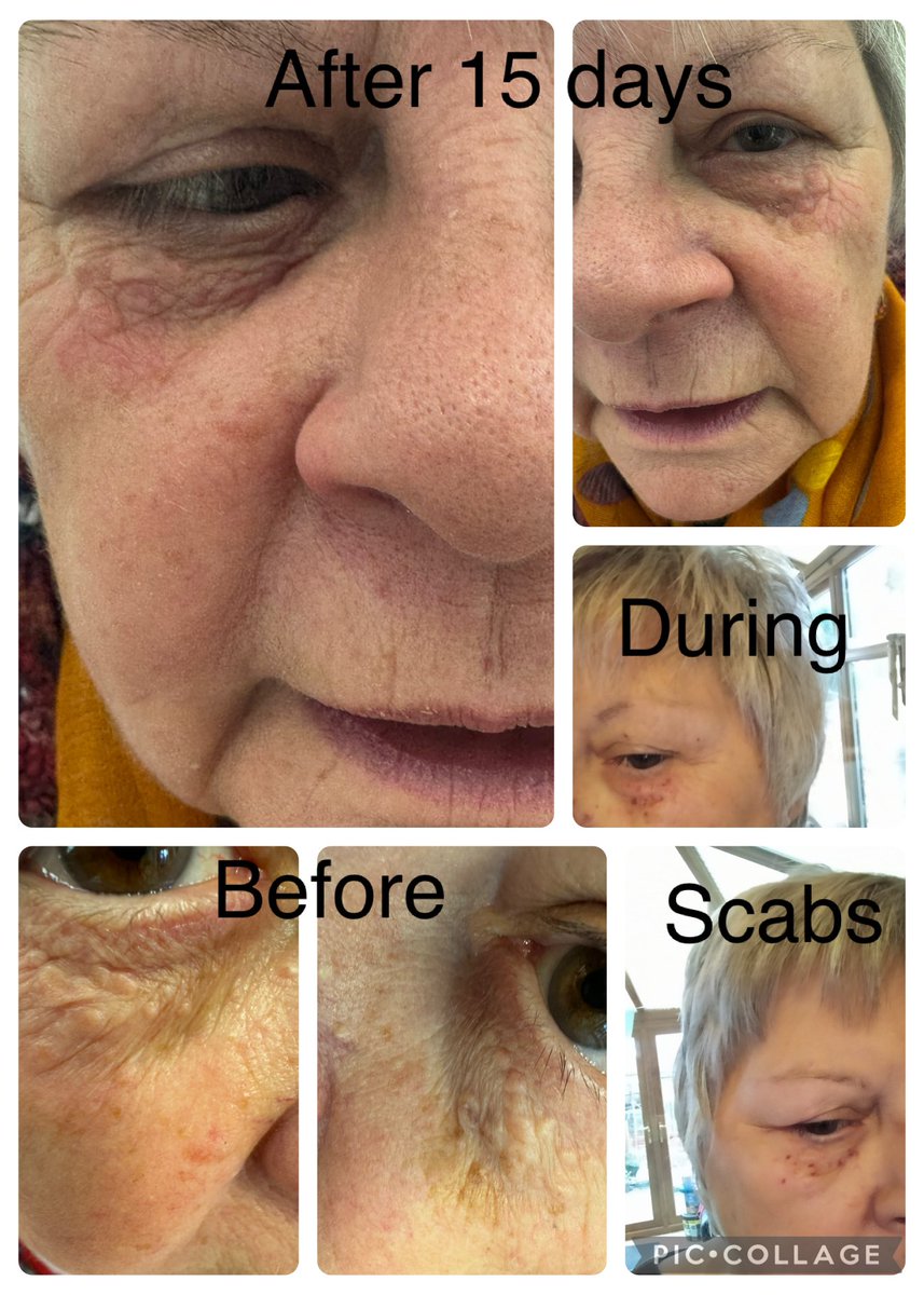 arorabeauty's tweet photo. Skin lesions clearance https://t.co/r8mr4iBLIT