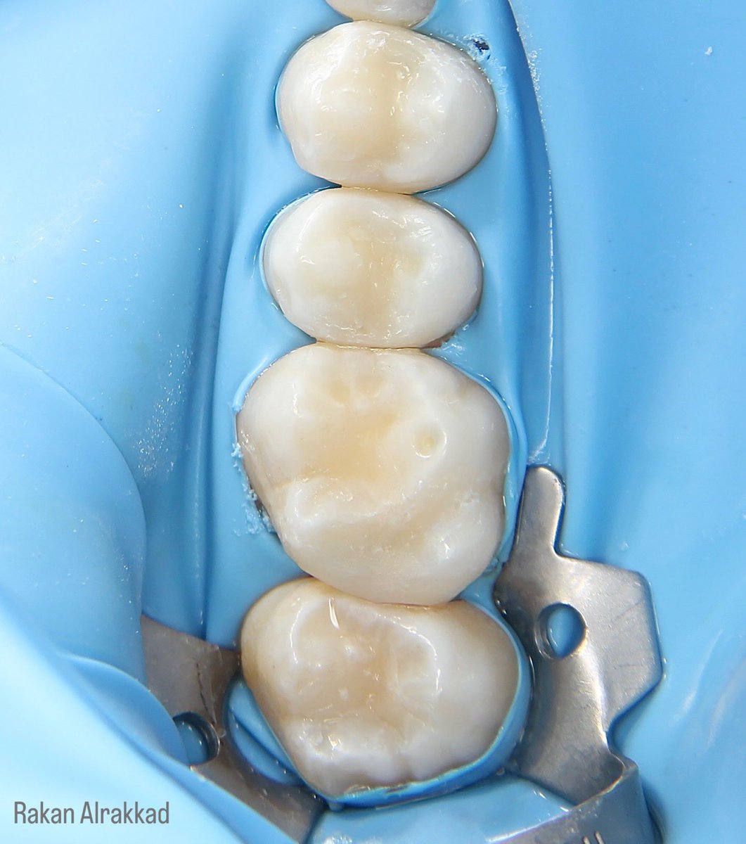 Composite restorations ✨