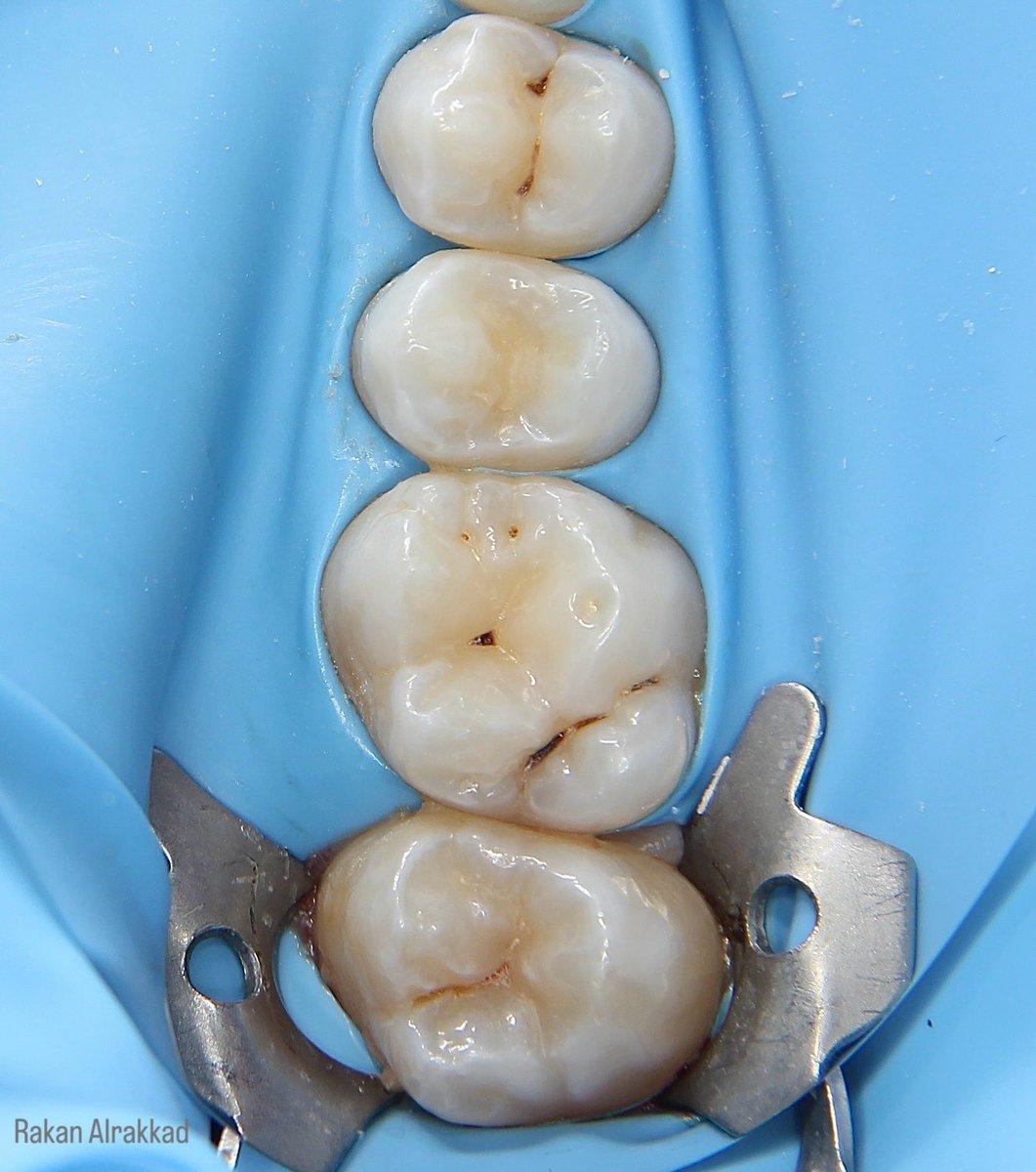 xx_rkon's tweet photo. Composite restorations ✨ https://t.co/5bESaxmrXO