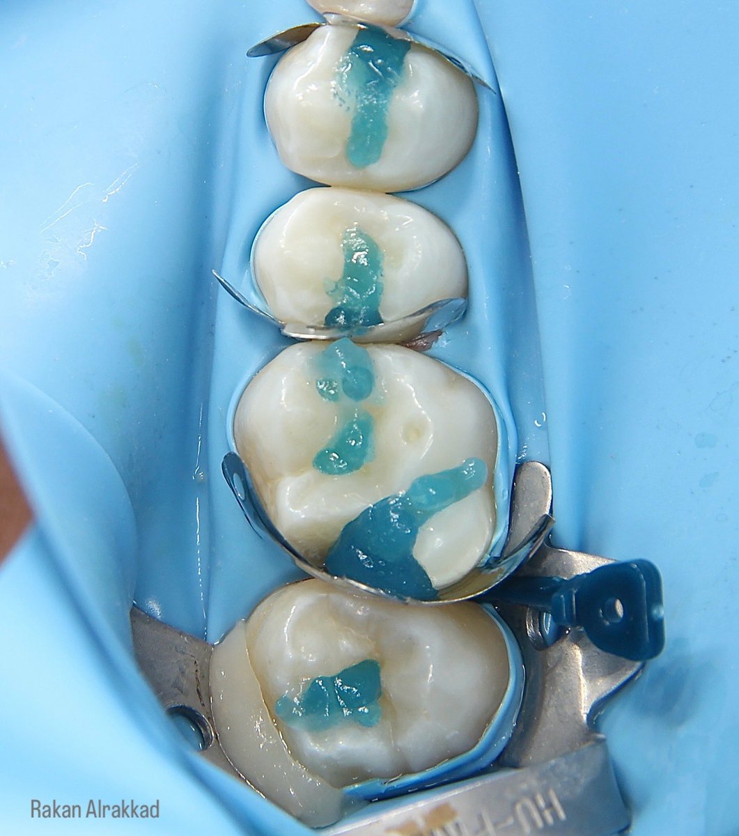 xx_rkon's tweet photo. Composite restorations ✨ https://t.co/5bESaxmrXO
