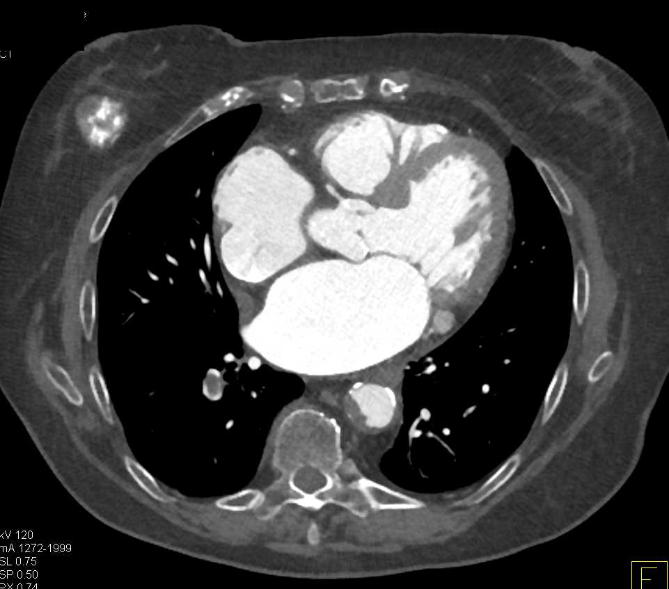 ctisus's tweet photo. Pulmonary Embolism (PE) and Left Atrial Thrombus: https://t.co/Km0vhl3x7g https://t.co/EaXK0L2QrW