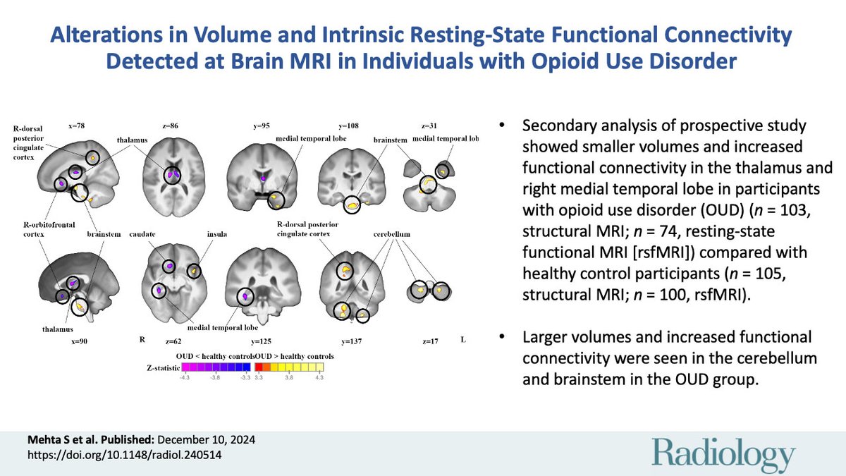 @RadiologyEditor (@radiologyeditor) on Twitter photo 🧠 MRI reveals structural & functional brain changes in opioid receptor–dense regions (e.g., thalamus, cerebellum) in individuals with opioid use disorder vs. controls. <a href="/SaloniYMehta/">Saloni Mehta</a> <a href="/DScheinost/">Dustin Scheinost</a> <a href="/YaleRadiology/">Yale Department of Radiology & Biomedical Imaging</a> <a href="/YaleMRRCneuro/">Yale-MRRC-Neuroscience</a> <a href="/YaleMed/">Yale School of Medicine</a> #Radiology
pubs.rsna.org/doi/10.1148/ra… 🧠 MRI reveals structural & functional brain changes in opioid receptor–dense regions (e.g., thalamus, cerebellum) in individuals with opioid use disorder vs. controls. <a href="/SaloniYMehta/">Saloni Mehta</a> <a href="/DScheinost/">Dustin Scheinost</a> <a href="/YaleRadiology/">Yale Department of Radiology & Biomedical Imaging</a> <a href="/YaleMRRCneuro/">Yale-MRRC-Neuroscience</a> <a href="/YaleMed/">Yale School of Medicine</a> #Radiology
pubs.rsna.org/doi/10.1148/ra…