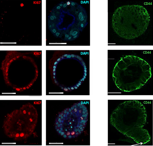 organoidscience's tweet photo. 🔬 Researchers investigated the early events associated with familial adenomatous polyposis using the intestinal #organoid model in a single-center study using biopsies from nonadenomatous and adenomatous #colonic mucosa of FAP patients.

🔓 https://t.co/CZsD3jfH9I https://t.co/NDUOwdoSAe