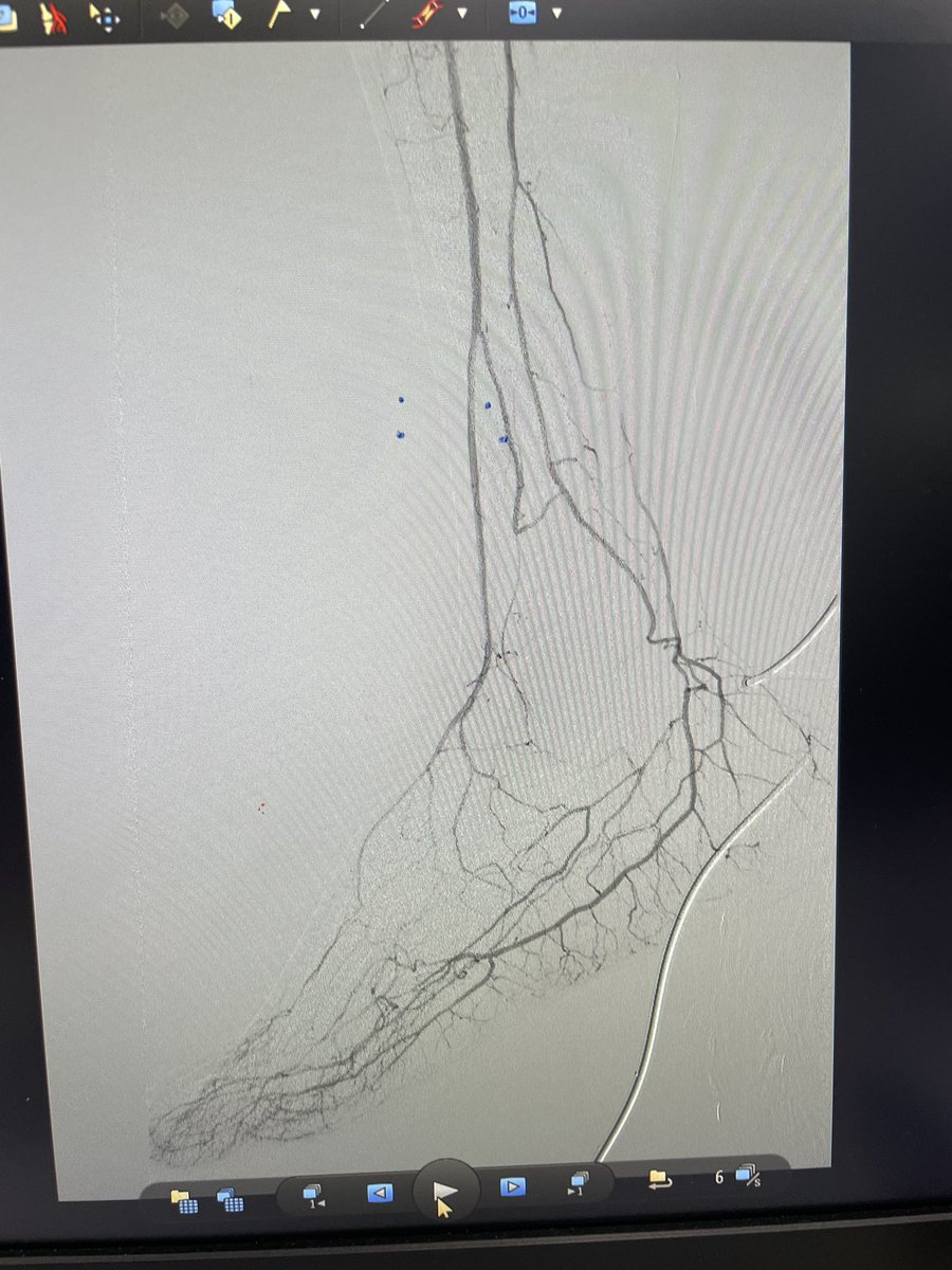 yuejianing's tweet photo. No single surgery can save all TAO-affected limbs, but this one is the most reliable. #limbsalvage #CLTIFighter #distalbypass https://t.co/CVC8pGceS4