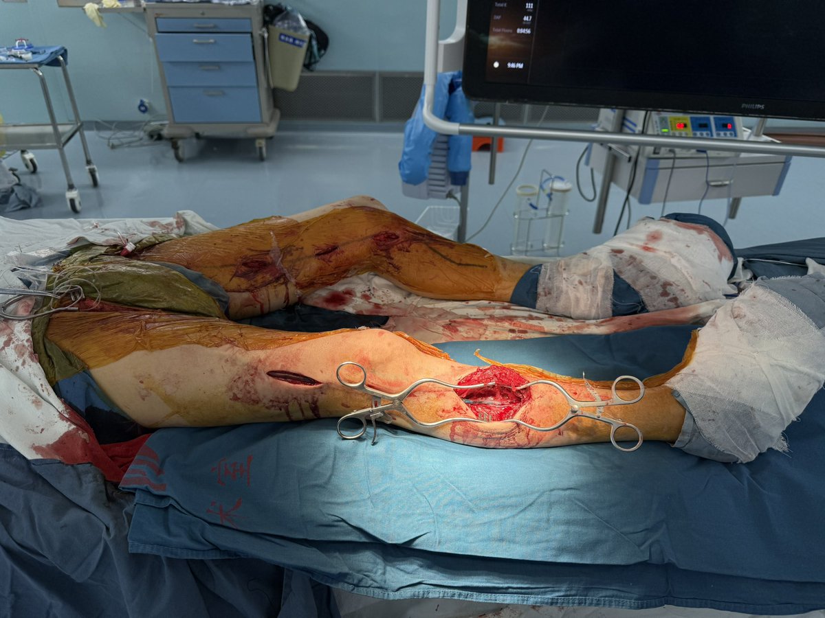yuejianing's tweet photo. No single surgery can save all TAO-affected limbs, but this one is the most reliable. #limbsalvage #CLTIFighter #distalbypass https://t.co/CVC8pGceS4