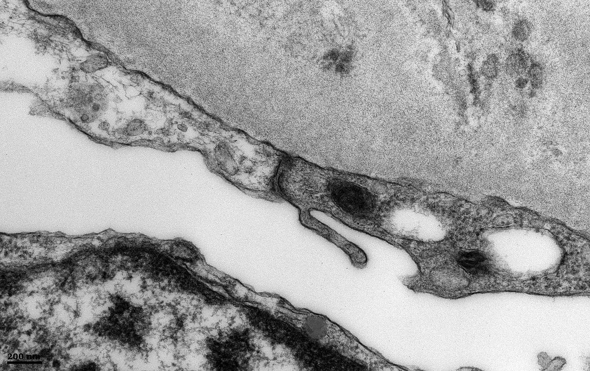 Patient w membranous nephropathy. #electronmicroscopy shows electron-dense deposits (arrow) lining Bowman's capsule (BC) at the vascular pole, but deposits are not evident further along BC. Presumably the transition point between #podocyte and parietal epithelial cell phenotypes.