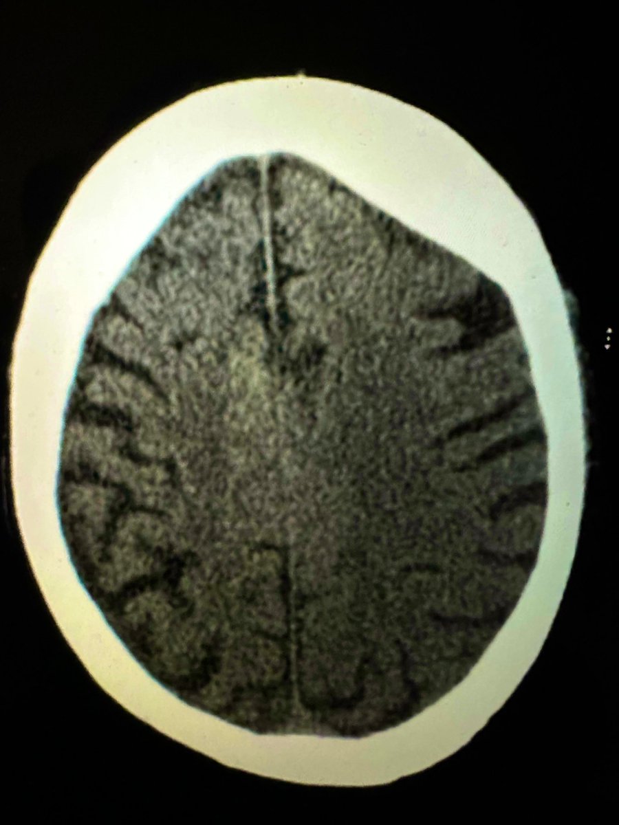 Convexity subarachnoid hemorrhage can be very subtle and easily missed on a CT scan. Look carefully at the CT scan before giving thrombolysis. Amyloid spells can cause focal neurological deficits mimicking ischemic stroke &amp; thrombolysis is harmful in this setting. #Stroke #MedEd