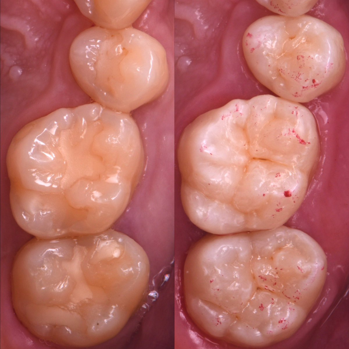みなさまご無沙汰しております。
来週木曜日夜19:00からとかなり直前の告知となりますが、トクヤマデンタル様主催のWEBハンズオンセミナーを開催します。
若干数ですが、現地参加も可能です。
ご興味のある方は是非お願いいたします。

お申込みはこちらとなります。
academy.doctorbook.jp/movies/1008051