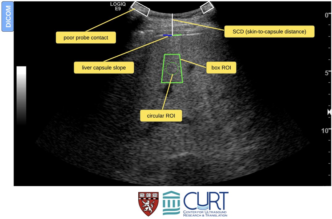 Thrilled to announce our new patent: “Ultrasound imaging techniques for shear wave elastography.” It automates optimal ROI placement for better shear wave elastography acquisition, and more! patents.justia.com/patent/2024039…