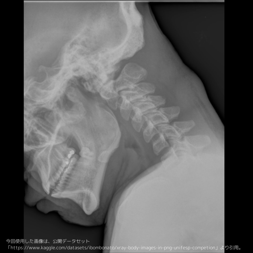 OpenCV_4's tweet image. 頸椎前屈撮影①

レントゲン画像だけでは、直接的にヘルニアが分かりづらいため頸椎側面画像に加え前後屈を撮影します。
椎間板（椎間腔）の狭さや動作具合を、頸椎側面画像と比較します。