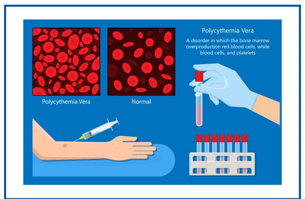 jclinicalmedres's tweet photo. Polycythemia, or erythrocytosis, is a blood disorder that occurs when the body has too many red blood cells. This causes the blood to thicken and become more difficult to flow, leading to serious health problems such as Blood clots and blood cancers.
#Polycythemia #erythrocytosis https://t.co/itOdKEULST