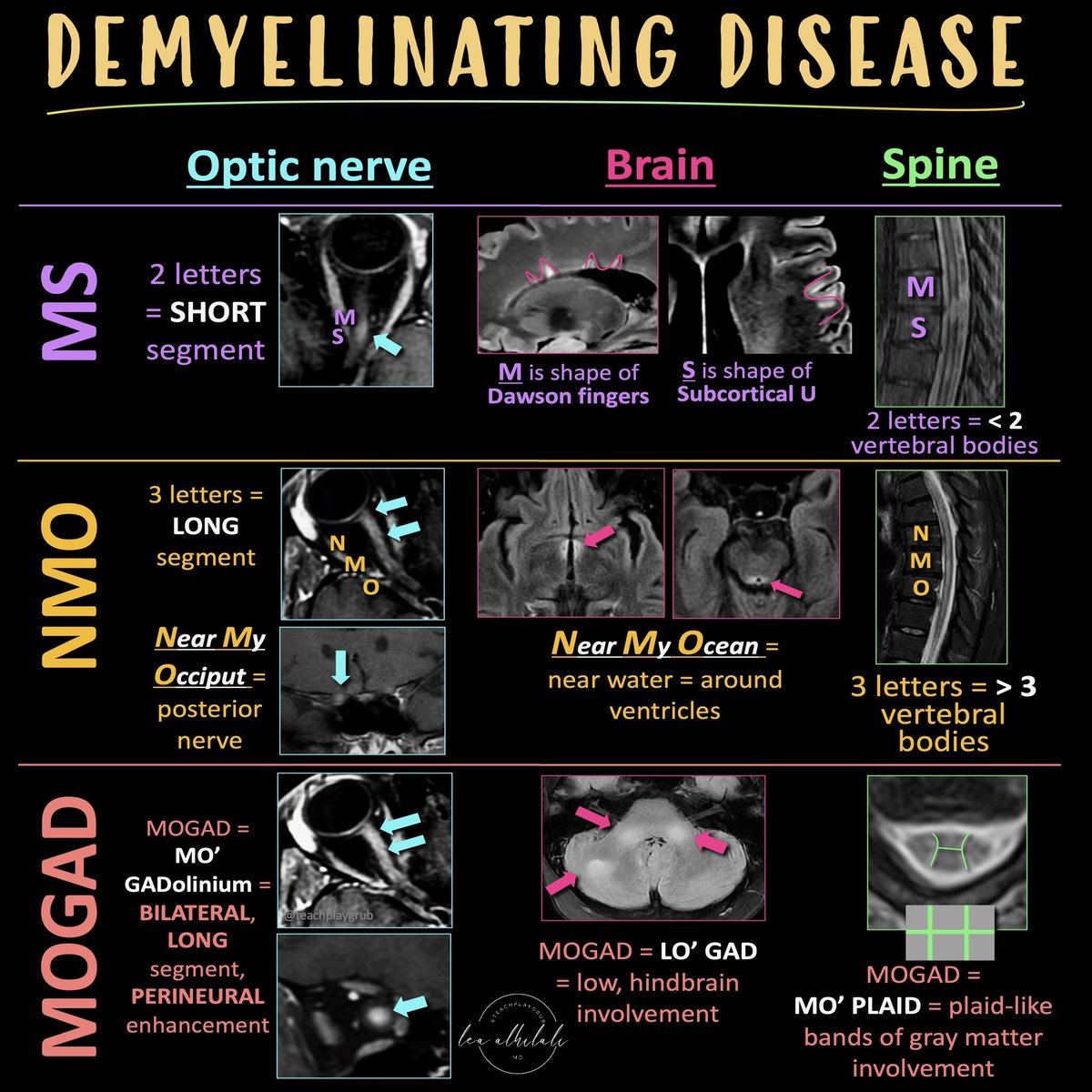 Lea Alhilali, MD (@teachplaygrub) on Twitter photo Have MULTIPLE questions about MULTIPLE sclerosis?
 
Having trouble seeing neuromyelitis optica?
 
In a fog about MOG?
 
Here’s the cheat sheet you NEED to distinguish the demyelinating diseases!
 
Demyelinating diseases predominantly involve the optic nerves, brain, & spine. Have MULTIPLE questions about MULTIPLE sclerosis?
 
Having trouble seeing neuromyelitis optica?
 
In a fog about MOG?
 
Here’s the cheat sheet you NEED to distinguish the demyelinating diseases!
 
Demyelinating diseases predominantly involve the optic nerves, brain, & spine.
