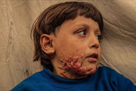 swilkinsonbc's tweet photo. Mohammed Maarouf isn’t even 5 years old — targeted by the israelis in an air strike on a school shelter in Jabalia: flames engulfed &amp; burnt his body https://t.co/PgbiIfWz8O