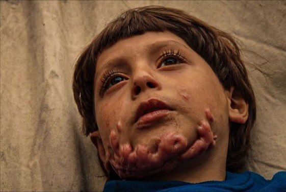 swilkinsonbc's tweet photo. Mohammed Maarouf isn’t even 5 years old — targeted by the israelis in an air strike on a school shelter in Jabalia: flames engulfed &amp; burnt his body https://t.co/PgbiIfWz8O