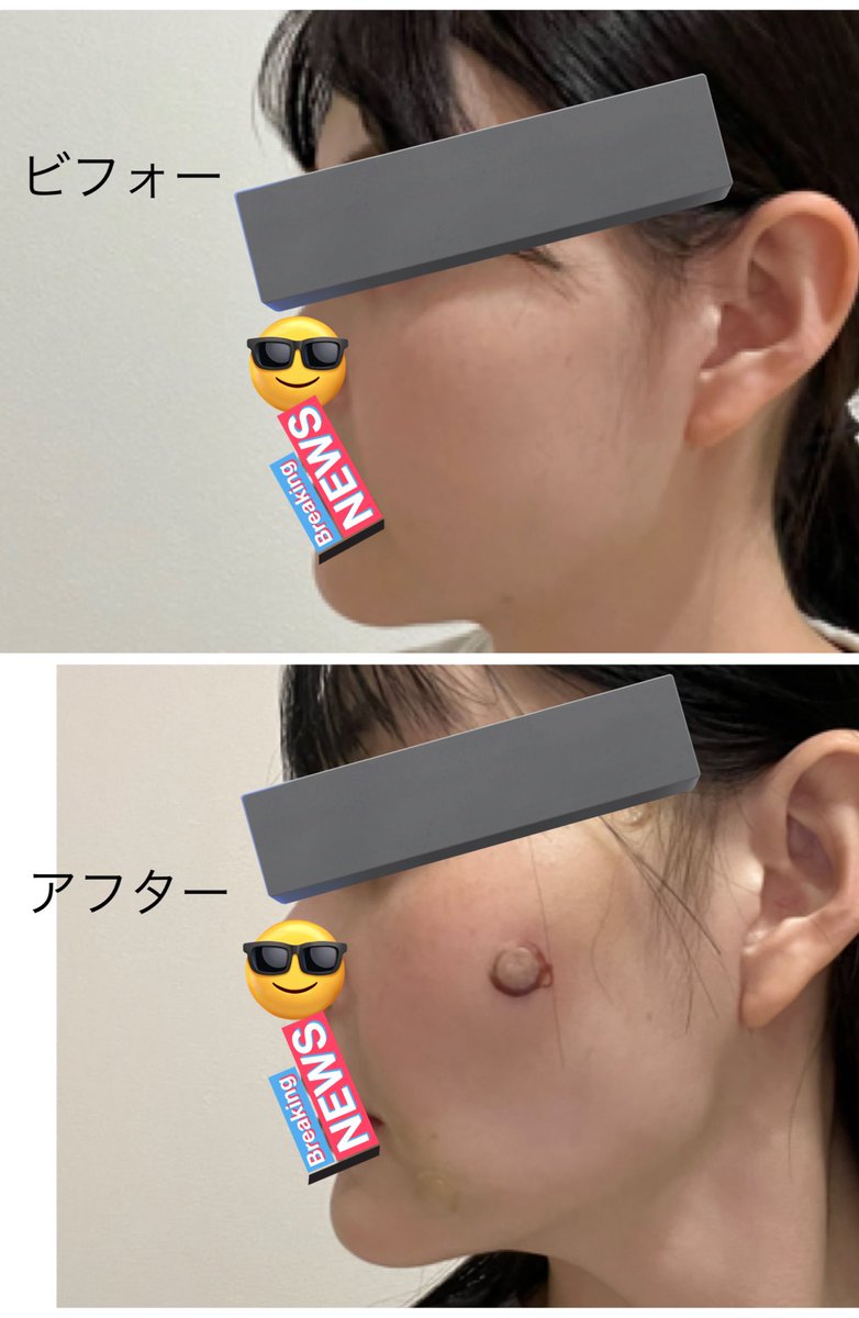 kaodeka_chan's tweet photo. BFライン歯科でずっと気になってた貴族部分の糸リフトしてきました！
終わった直後から小顔&amp;法令線が薄くなって感激しました🥲🤍CT撮影してしっかりカウンセリングしてくださって本当満足です！ https://t.co/XgApvqB5cC