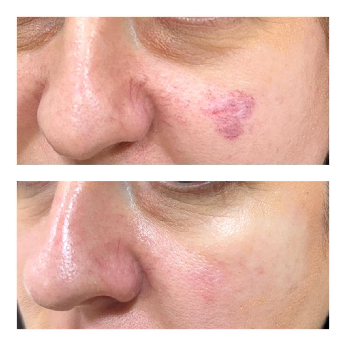 CandelaMedical1's tweet photo. Another fabulous result from Dr. Pescaru using the #Vbeam to address her patient's facial lesion!
REPOST dr.ionapescaru
Small lesion but with a huge impact for the patient! We managed to treat it with the Vbeam laser, 6 sessions 1 month apart!
#vascularbirthmark #vascularlaser https://t.co/0Bd4MLMc5o