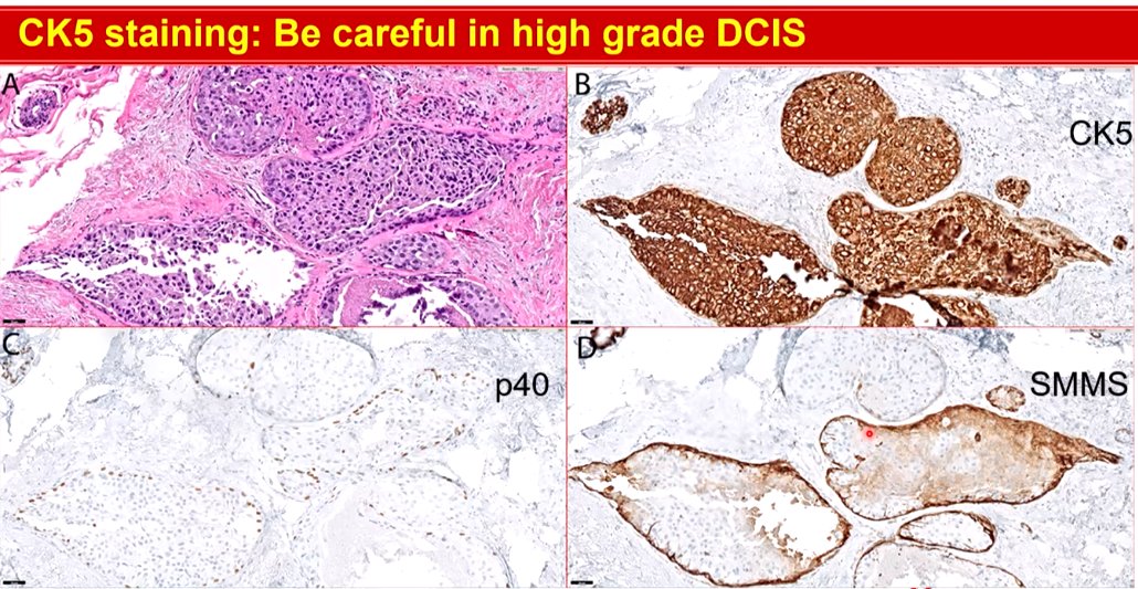 Janiranavarro's tweet photo. Breast-CK5/6 pitfalls
Be careful in high grade DCIS, they can stain CK5/6 and be ER negative.
Dr. Li #CAP24 #pathology #pathologists #PathTwitter #PathX #pathresidents #pathfellow #breastpath