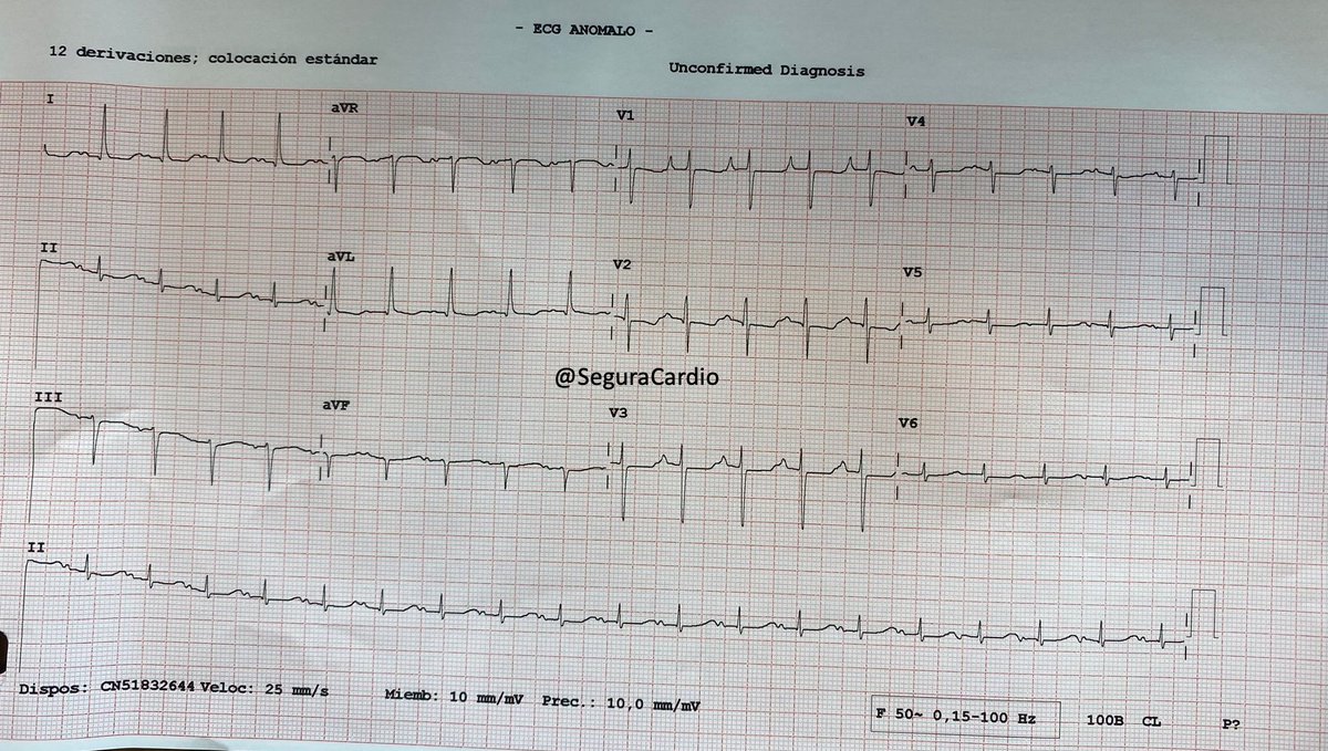 SeguraCardio's tweet image. Spot diagnosis‼️
#ECGChallenge
