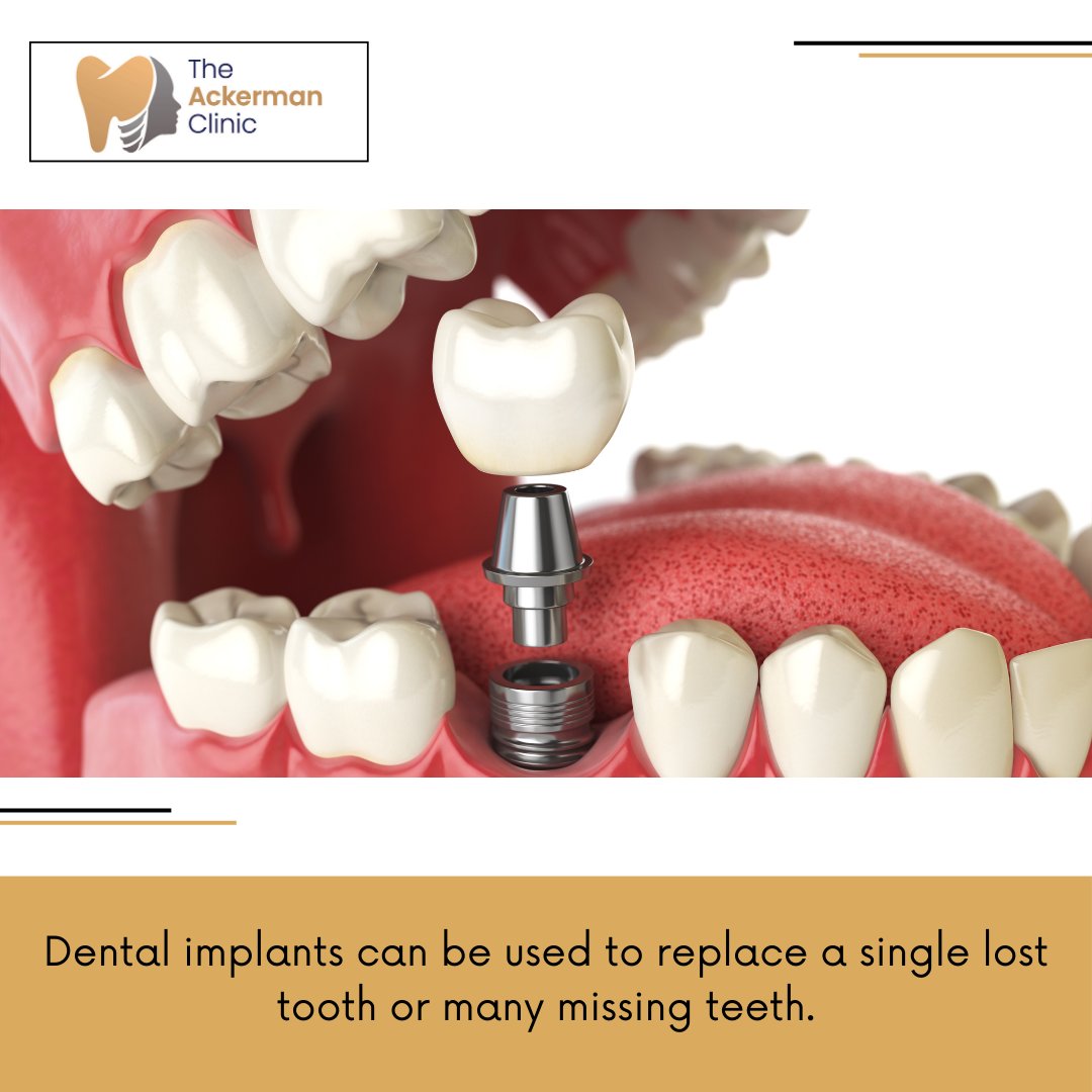 AckermanClinic's tweet image. Say goodbye to gaps and hello to a confident, beautiful smile! Our dental implants offer a permanent solution for missing teeth, providing natural-looking, fixed teeth that function just like your own.

#DentalImplants#HampshireDentist #TeethImplants #HampshireDental