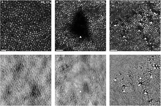 Megan Vaughan et al. investigate Changes in Waveguiding Cone Photoreceptors and Color Vision in Patients With Diabetes Mellitus, iovs.arvojournals.org/article.aspx?a…. 
<a href="/megan_hv/">Megan Vaughan</a> <a href="/UCLeye/">UCL Institute of Ophthalmology</a> <a href="/Moorfields/">Moorfields Eye Hospital NHS Foundation Trust</a> <a href="/CityUniLondon/">Anna</a>