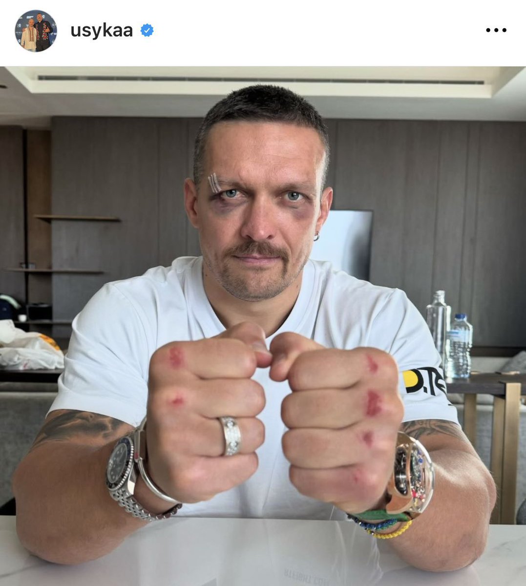 BoxingKingdom14's tweet photo. How Oleksandr Usyk looked the day after his fight with Tyson Fury, in May. https://t.co/R1rcjDwm2w