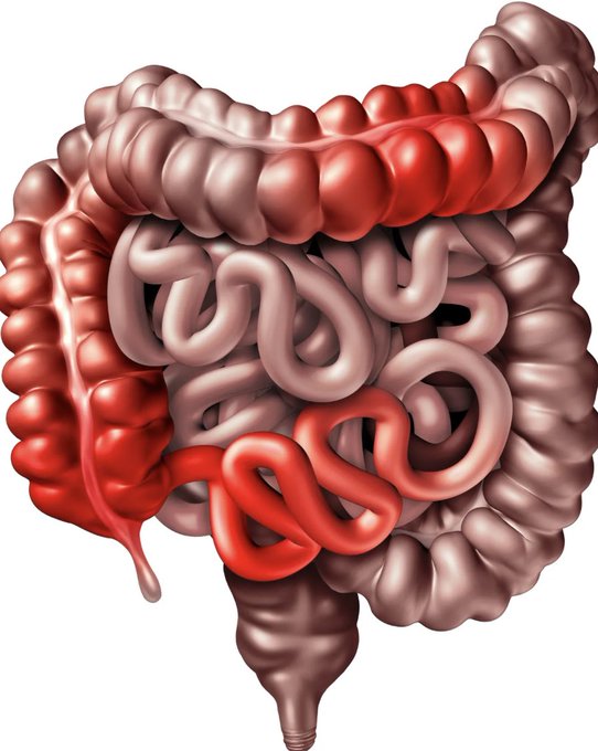 Muchos creen que el intestino solo digiere alimentos..

Pero un intestino inflamado puede causar depresión y enfermedades graves.

Te comparto 18 frases prácticas para revertir años de daño y recuperar tu salud.