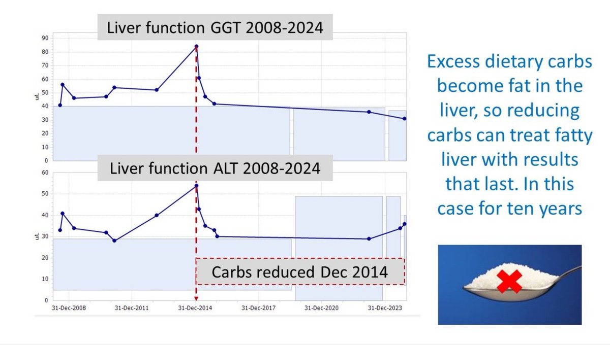 lowcarbGP's tweet image. Low carb and keto diets can help reverse fatty liver a condition that now effects 38% of the world’s population Our paper here pubmed.ncbi.nlm.nih.gov/39200999/ In this case TEN YEARS of normal liver function and counting 👍😊