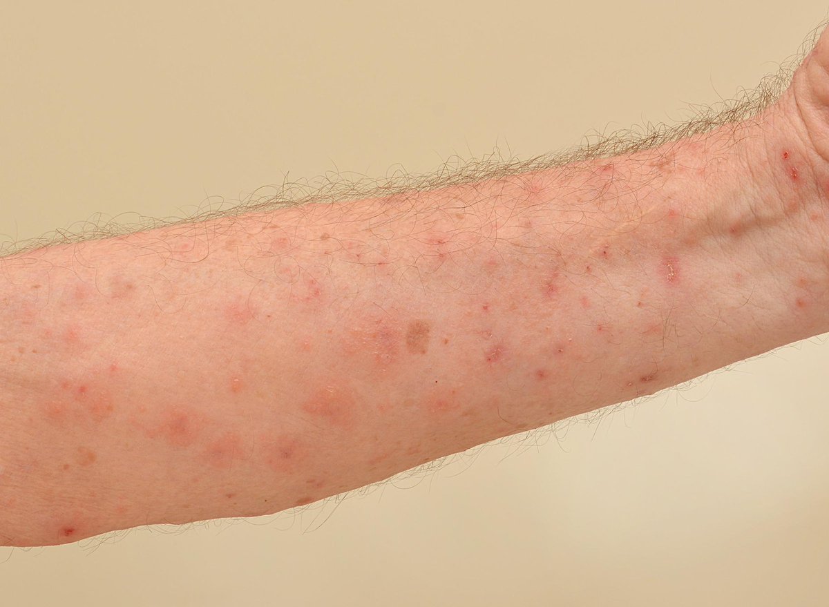 SaryMutwakil's tweet photo. مدى انتشار وباء الscabies في أمدرمان بقا مخيف شديد وما مفهوم هل هو بسبب poor personal hygiene ولا resistant strain ولا re infection  
على العموم الناس دي بتتحك لمن عينها تمرق وتاخد علاجات وبرضو مافي فايدة 
نصيحة للجميع اي زول ظاهرة في جسمه حبوب زي دي أو قاعد يتحك ابعدو منه https://t.co/r83j2Qzs62