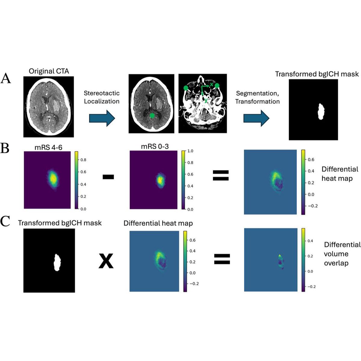 JNIS (@jnis_bmj) on Twitter photo Can we predict outcomes for basal ganglia intracranial hemorrhage (bgICH) using spatial imaging data! By modeling bgICH location, <a href="/aKashkoushMD/">Ahmed Kashkoush</a> et al. identified key areas linked to worse prognosis, offering potential for better surgical selection and prognostication. #ICH Can we predict outcomes for basal ganglia intracranial hemorrhage (bgICH) using spatial imaging data! By modeling bgICH location, <a href="/aKashkoushMD/">Ahmed Kashkoush</a> et al. identified key areas linked to worse prognosis, offering potential for better surgical selection and prognostication. #ICH