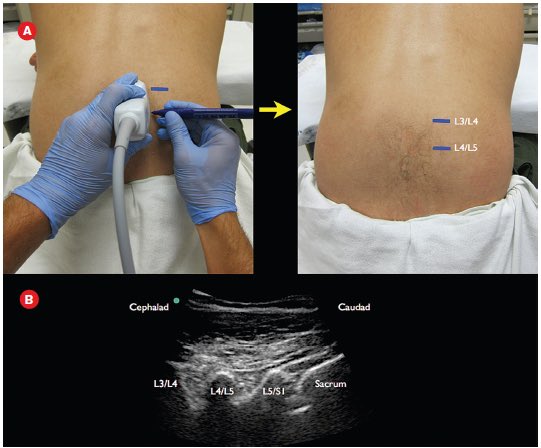 NephroP's tweet photo. #POCUS guided lumbar puncture
#FOAMed #FOAMcc 
🔗 https://t.co/YP8kwIdi2V https://t.co/EphD1A1JO2