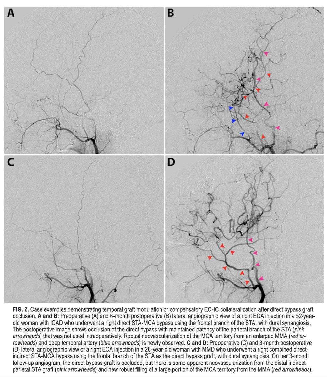 TheJNS's tweet photo. #OnlineFirst: The impact of cerebrovascular steno-occlusive disease subtype on surgical and clinical outcomes after direct STA-MCA bypass surgery. 

https://t.co/MTRuK2KBRE. https://t.co/apJ1kVqMsv