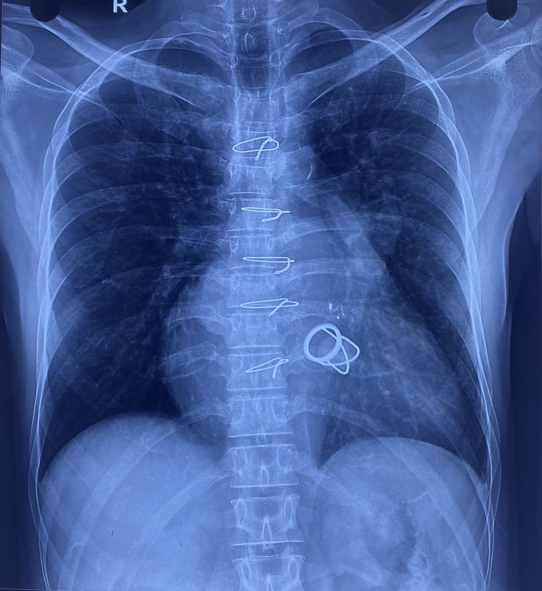 DrRajeshG1's tweet photo. X-ray for fellows. Carefully see https://t.co/IXrYm5xeJL