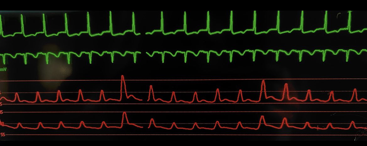 Eugene Yuriditsky (@cardsnyc) on Twitter photo How does positive pressure impact the right ventricle?
Check out our approach to thinking through, and teaching heart-lung interactions with mechanical ventilation.
atsjournals.org/doi/10.34197/a…
<a href="/carlosalviar/">Carlos L. Alviar MD, FACC</a> <a href="/emireles_c/">Eduardo Mireles-Cabodevila</a> <a href="/ATSScholar/">ATS Scholar</a> How does positive pressure impact the right ventricle?
Check out our approach to thinking through, and teaching heart-lung interactions with mechanical ventilation.
atsjournals.org/doi/10.34197/a…
<a href="/carlosalviar/">Carlos L. Alviar MD, FACC</a> <a href="/emireles_c/">Eduardo Mireles-Cabodevila</a> <a href="/ATSScholar/">ATS Scholar</a>