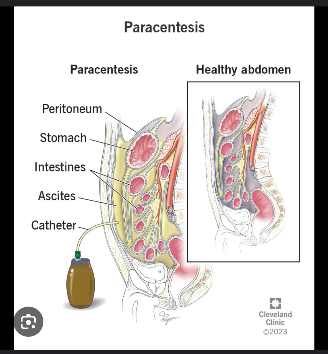 A7Shehabi's tweet photo. @mog_china -هذي البقره عندها مشكله في الكبد 😁
-هذا اسمه بالطب paracentesis
- يكون المريض في الغالب مريض كبد 
 - في الغالب يناوب عليه المريض مره كل اسبوع الى اسبوعين https://t.co/9wGGEtpMKw
