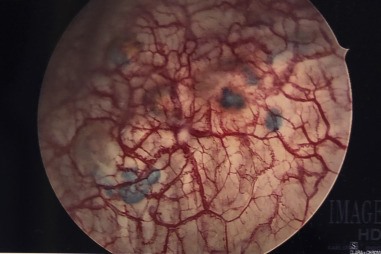 AJOG_thegray's tweet photo. Chocolate cysts found on cystoscopy- https://t.co/lhY3KiL9QP https://t.co/ARHV43r7Uf