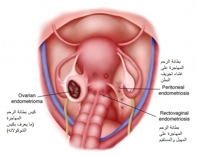 BanderKutbi's tweet photo. بطانة الرحم المهاجرة
(مقال مطول)

اضرار البطانة المهاجرة كبيرة جدا على جودة حياة المرأة وعلى خصوبتها 

احاول في هذا المقال اعطاء اكبر قدر من التفاصيل بطريقة مبسطة لعل الله يجعل فيها فائدة للجميع

🔅اولا: الاعراض

الاعراض الاساسية هي الالم المبرح الشديد كامل ايام الدورة (طول الوقت دون رحمة ودون توقف وليس فقط اول يوم او يومين) والذي يوقف كل نشاطات الحياة ويجعل السيدة لا تستطيع ان تمارس اي نشاط (عمل دراسة بيت الخ)

عادة ما تحتاج الى اخذ ابر مسكنة كل يوم او حتى مرتين في اليوم - وذلك بحد ذاته يضر الكلى كثيرا

حسب مرحلة المرض (يقسم لأربعة مراحل) 

الاعراض قد يكون منها ايضا:
- دم مع البول اثناء الدورة
- دم مع البراز - كرمتم - اثناء الدورة
- الم شديد مع العلاقة الزوجية (دون وجود التهابات اوفطريات او جفاف مهبلي - يعني حتى مع استخدام مزلق) والالم مرتبط بالحركة

قد تكون بطانة الرحم المهاجرة دون اعراض (صامتة)

🔅ثانيا - التشخيص:

- الاعراض اساس التشخيص في العادة

- وجود اكياس بطانة الرحم المهاجرة (اكياس الشوكولاته) على المبيضين وتكون واضحة جدا في التصوير التلفزيوني (المهبلي بالذات) ولكن ذلك يحتاج الى استشاري تخصص دقيق (اشعة او تأخر انجاب) بتدريب متخصص في ذلك والى جهاز ممتاز. 
الاكياس ايضا واضحة في الرنين المغناطيسي

- الرنين المغناطيسي يبين الالتصاقات الى حد ما في تجويف البطن ويساعد كثيرا في التشخيص

- الوسيلة الذهبية (تشخيص 100%) هي جراحيا المنظار البطني  و رؤية المرض بالعين المجردة مع اخذ عينات لتحليلها 
يمكن ايضا جراحيا ازالة البطانة المهاجرة الى حد ما - اكمل الموضوع في جزئية العلاج

في الغالب لا نلجأ للجراحة سوى للعلاج (الاعراض والرنين والتصوير التلفزيوني يكفون عادة)

🔅ثالثا: سبب التسمية وشرح فكرة المرض

- بطانة الرحم مكانها الاساسي ببساطة تجويف الرحم
- البطانة هي مكان غرس الجنين عند تخصيب البويضة
- الجنين - مثله مثل العروس - يحتاج الى "بيت" او "سرير" جديد  ليغرس ولا يمكن انغراسه في سرير (بطانة الرحم) القديمة 
- لذلك في حال عدم حدوث حمل يتم التخلص من السرير (البطانة القديمة) و تنزل على شكل الدورة الشهرية (ليست دما منحبسا ولا فاسدا) ليتم تكوين بطانة رحم جديدة لاستقبال الجنين الجديد
- يوجد غشاء بين الجزء السفلي (الملاصق لعضله جسم الرحم) والرحم ليحمي الرحم من ان تنمو البطانة وتتغلغل في الرحم ذاته (عندما يحصل ذلك يسمى التغدد الرحمي)

- عندما تتواجد البطانة في اي مكان اخر في تجويف البطن تسمى البطانة المهاجرة

- تنمو كل شهر وعندما تأتي الدورة(تتكسر البطانة في تجويف الرحم وتنزل من المهبل) تتكسر ايضا البطانة التي خارج الرحم - ولا تنزل فتسبب مشاكل واضرار كثير حسب المكان

🔅رابعا: امثلة عن اماكن تواجد بطانة الرحم المهاجرة واضرارها:

1. على المبيضين:
- تكون اكياس تنمو فيها البطانة كل شهر وعندما تنزل الدورة طبعا يظل الدم اللزج الغني بالغدد وانسجة البطانة في الكيس - يتم امتصاص السوائل(الماء) ويبقى السائل ثقيلا لزجا بني اللون يشبه الشوكولاته السائلة عند ازالته جراحيا
- تتراكم السوائل اللزجة (ويأكل الكيس اجزاء اكثر من جسم المبيض) مع كل دورة شهرية فيزيد حجمه كثيرا ويصل الى مقاسات كبيرة جدا
- عادة كل ما زادت احجام اكياس البطانة كلما زادت الاعراض سوءا وكلما نقص المخزون

الضرر الاكبر في تلك الاكياس هي انها كلما تنمو البطانة فهي "تأكل" (تدمر) جزأ بسيطا من قشرة المبيض والتي تحتوي على البويضات

تدمير البويضات يقلل المخزون وبالتالي الخصوبة تقل مع الوقت

ذلك يؤدي الى فشل المبايض المبكر وما قد نسميه "العقم" او "سن اليأس من المحيض" المبكر (انقطاع الدورة)" عندما ينتهي المخزون

حينها تنتهي الام المرض ولكن بعد فوات الاوان حيث انتهت الخصوبة

2. في غشاء تجويف البطن 

يؤدي الى التصاقات في تجويف البطن وتتسبب في الام الحوض ومشاكل في الامعاء 

الالتصاقات الشديدة تثبت الرحم والمهبل في اماكنها (تسمى الحوض المتجمد) مما يجعل العلاقة الزوجية جدا مؤلمة

3. وجود البطانة المهاجرة في القولون او المثانة يجعل النزيف مع البول او البراز - كرمتم - يصاحب الدورة الشهرية

🔅 خامسا - العلاج:

الخيار الجراحي: ممتاز في يد جراح متخصص بارع (تخصص دقيق اورام نسائية او جراحة نسائية تداخلية) 

مشكلته هو ان رجوع المرض امر وارد جدا لأن اي "قطعة/منطقة" بسيطة يتركها الجراح دون ازالتها (عادة كي بالليزر) تعود ببطء عبر السنين مع كل دورة شهرية و

كأنك ما غزيت

الخيار الدوائي:
الاساس مع او دون الجراحة

الافضل عادة هو استشاري تخصص دقيق تأخر الانجاب والغدد التناسلية (مع التأكد من مؤهلات الطبيب)

الهدف؟ جودة حياة عالية (دون الم) قدر الامكان والاهم من ذلك الحفاظ على مخزون المبيضين 

هل يوجد علاج نهائي كامل؟ 

فقط ازالة المبيضين جراحيا (بالتالي دخول سن اليأس من المحيض بشكل دائم دون رجعة)

بالتأكيد لن تختار ذلك اي سيدة الا في اندر ما ندر

الحلول الدوائية غالبا طويلة الامد قد تمتد لسنوات طويلة

لن اكتب عن العلاج اكثر من ذلك لأن مكانه العيادة حسب حالة وظروف كل سيدة

ملاحظة: البطانة المهاجرة مرض "ينام" نوما عميقا اثناء الحمل والرضاعة الكافية 

الحامل والمرضع في اجازة من اضرار المرض - لذلك نجدهن يحببن الحمل 

🔅سادسا - البطانة المهاجرة والخصوبة

نعم التأثير في حالات كثيرة واضح وكبير (التصاقات + ضرر المخزون)

حسب الحالة وتفاصيل كل زوجين:

لا نضيع الوقت

هل نحاول طبيعي؟ حسب المخزون واشعة الصبغة وتحليل السائل المنوي للزوج

حقن مجهري؟ حل ممتاز في حالات كثيرة

امور عديدة نأخذها في الحسبان عند تقييم خصوبة السيدات المصابات بالبطانة المهاجرة

ماذا نفعل اثناء الفترات بين كل حمل وحمل؟ 

يجب التحكم في المرض بشكل كاف حتى لا يستمر الضرر

النصيحة الاساسية؟ 
استشاري تخصص دقيق تأخر الانجاب والغدد التناسلية بمجرد التشخيص لوضع خطة مناسبة ومناقشة كافة التفاصيل

ملاحظة 1: ارجوا السماح في حالة التقصير او عدم الوضوح - سأقوم ان شاء الله بتعديل المقال واعادة نشره كل عدة اشهر 

ملاحظة 2: الغرض هو التوعية وليس العلاج 

ملاحظة 3: سأقوم قدر الامكان بالاجابة على الاستفسارات طالما انها ليست استشارات طبية او علاجية

كالعادة مع كل مقال:
ان اعجبكم ارجوا الاعجاب Like - و اعادة التغريد Retweet - و التعليق ولو بكلمة

وصلى الله على سيدنا محمد وعلى اله وصحبه وسلم تسليما كثيرا طيبا مباركا