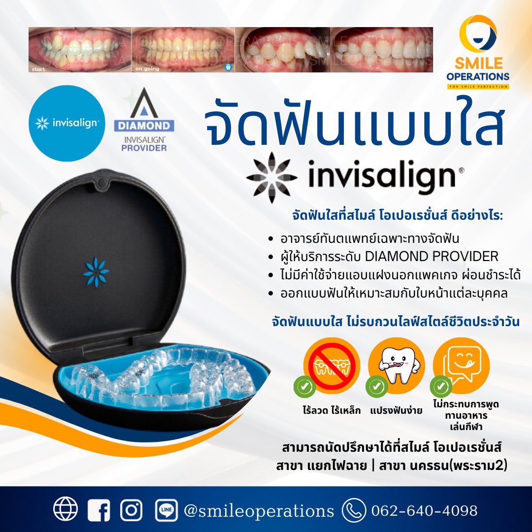SmileOperations's tweet photo. #จัดฟัน #จัดฟันใส #ดัดฟัน #อินวิสไลน์ #จัดฟันแบบใส https://t.co/ylWLrIwoWT