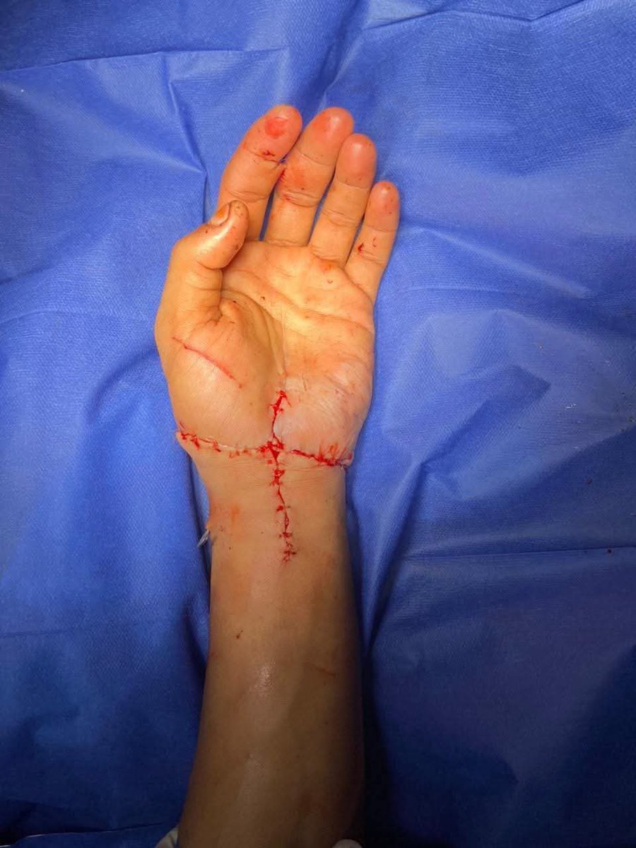 💢فريق طبي مصري بمستشفى القصر العيني ينجح في زراعة يد مبتورة لشاب بنجاح ❤🇪🇬

المريض يبلغ من العمر 20 عاما وصل المستشفى بيد مبتورة وكسور في الذراع

تم تثبيت كسور الكوع واليد وتوصيل الأوردة والشرايين والأعصاب والأوتار الخاصة باليد

#الخلاصة