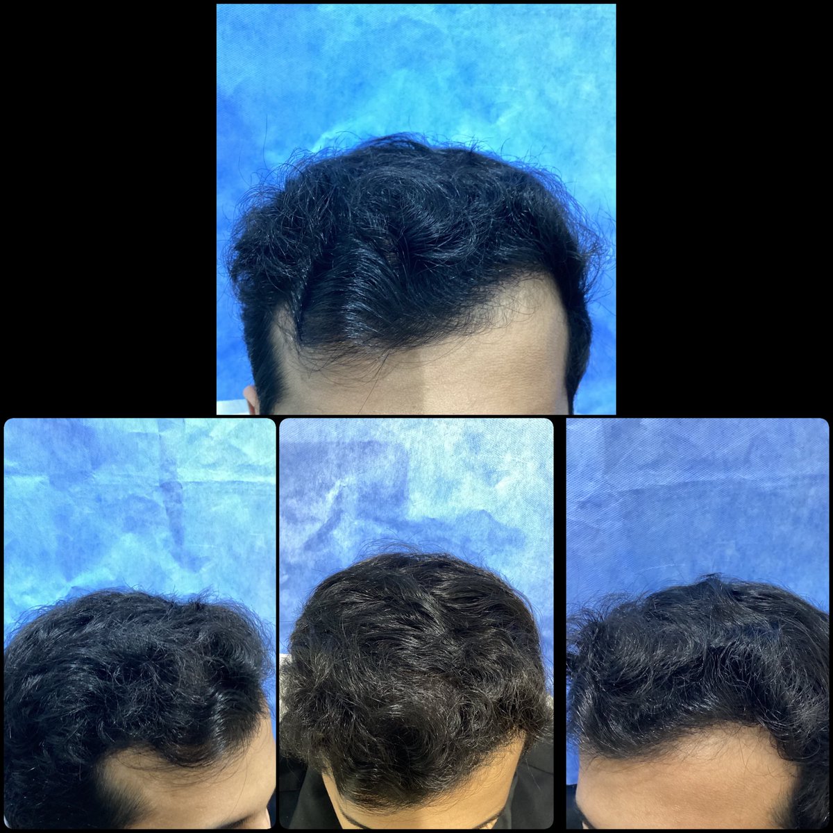 قبل وبعد عملية #زراعة_الشعر

نلاحظ جمالية نتيجة الخط الأمامي وذلك بالحرص على محاكاة الرسمة الطبيعية وعدم المبالغة في تنزيل الخط

مع المتابعة الطبية والالتزام بالخطة العلاجية 👌